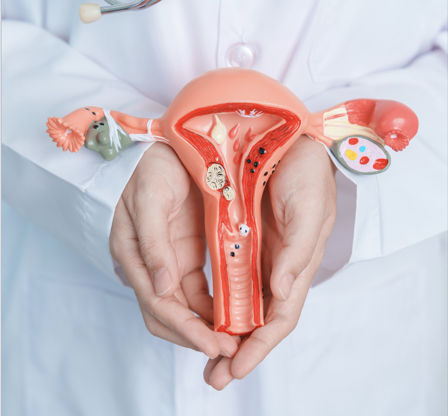 A doctor holding a model of the uterus that has several fibroids in it. Fibroids often times will cause abnormal bleeding